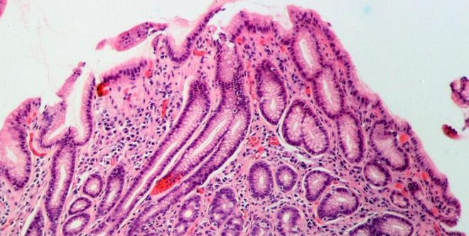 Helicobacter pylori: Así es la infección que padece la mitad de la población mundial Helicobacter pylori: Así es la infección que padece la mitad de la población mundial
