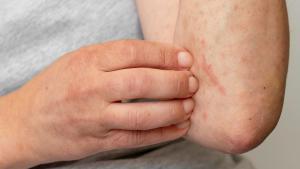 Expertos alertan del aumento de casos de dermatitis por contacto