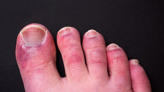 Esta secuela de la COVID persistente afecta a manos y pies, y no es fácil de controlar