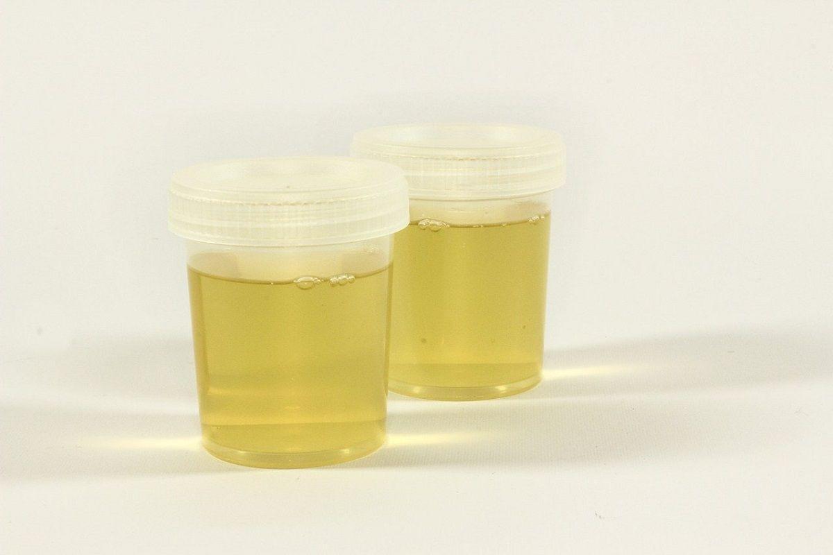 ¿Qué dice el color de la orina de nuestro estado de salud? ¿Qué dice el color de la orina de nuestro estado de salud?
