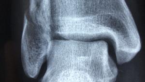 Osteoporosis: ¿Por qué se rompen tan fácil las vértebras, la cadera o las muñecas?