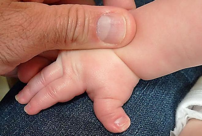 ¿Qué es el Síndrome de Rubinstein Taybi, también llamado enfermedad de los dedos gordos?