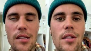 Síndrome de Ramsay-Hunt: Así es la enfermedad que ha paralizado la cara de Justin Bieber