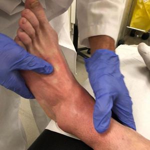 Así está el tobillo de Crutchlow Así está el tobillo de Crutchlow