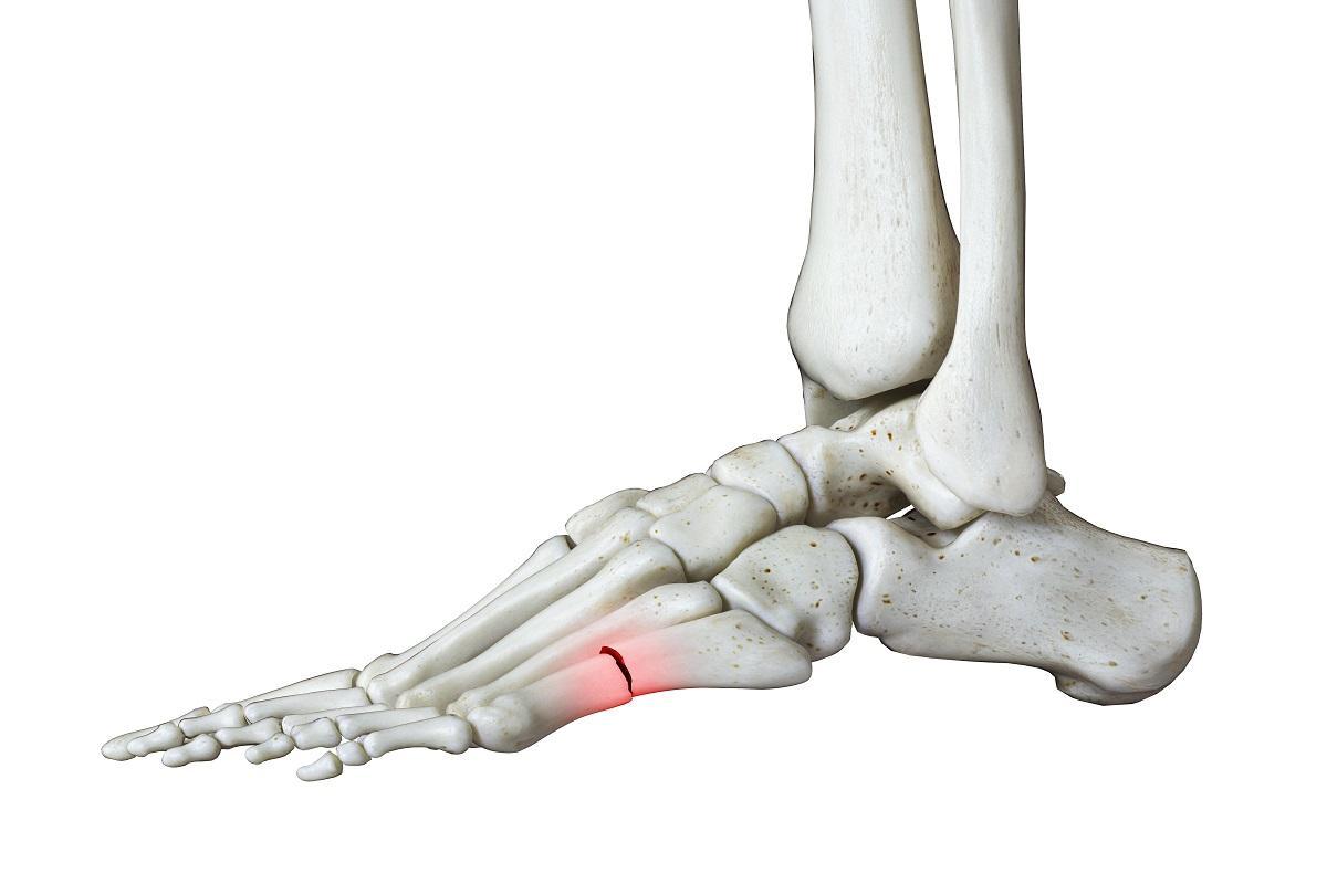 ¿Qué son las fracturas por estrés que se producen en los pies?