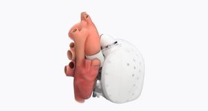 Así es el corazón artificial de Carmat que podría salvar vidas Así es el corazón artificial de Carmat que podría salvar vidas