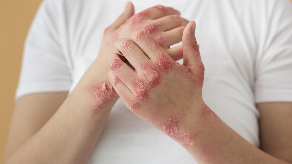 Psoriasis las complicaciones de esta enfermedad, más allá de los