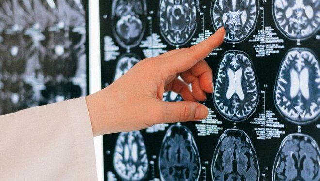 Sialorrea: ¿El exceso de saliva puede ser un problema de salud o un signo de alarma? Sialorrea: ¿El exceso de saliva puede ser un problema de salud o un signo de alarma?
